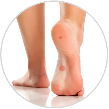 Areas of Pain Caused by Plantar Fasciitis